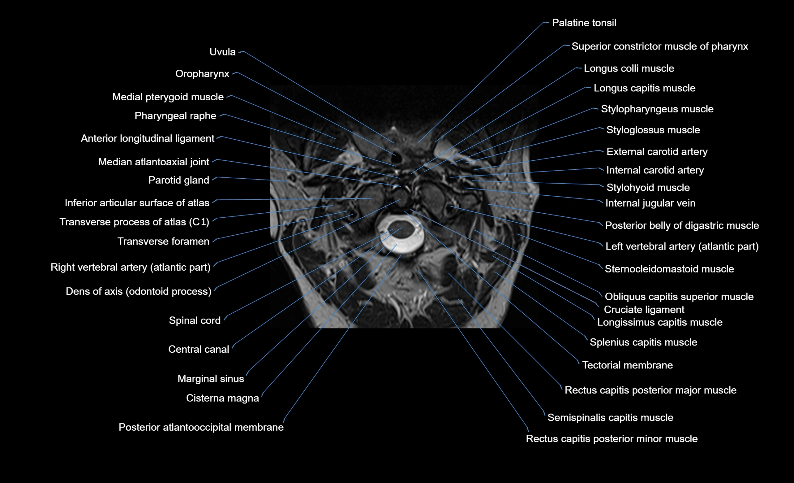cervical spine cross sectional MRI anatomy  3T MRI axial  image-img-00001-00006.webp